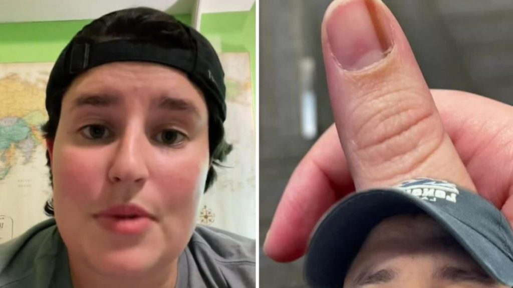 Tanda dan gejala melanoma sublingual pada seorang wanita Amerika yang memperhatikan 'garis dingin' di bawah ibu jarinya selama 10 tahun