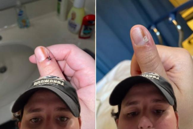 Pria berusia 25 tahun itu didiagnosis dengan melanoma subungual, sejenis kanker kulit langka yang terjadi di bawah kuku, setelah menjalani biopsi.