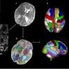 Ini menunjukkan pemindaian otak pada periode perinatal yang menyoroti area yang terkait dengan autisme