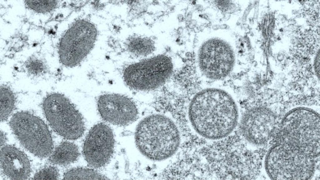 Monkeypox: Kematian pertama AS akibat virus dikonfirmasi di Los Angeles County